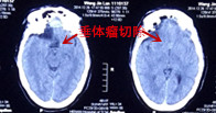 垂體瘤術后.png